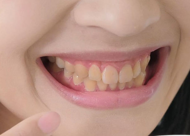 brown spots on teeth