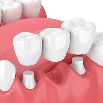 dental crowns and tooth bridges