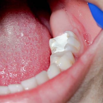 Filling/Cavities Treatment
