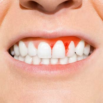 periodontitis or gum disease