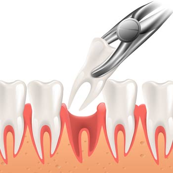 tooth extraction or dental extraction